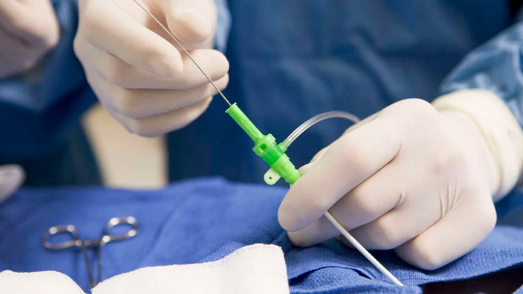Tratamento Minimamente Invasivo do Aneurisma da Aorta: Uma Revolução na Cirurgia Vascular